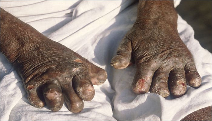 566766-leprosy2 (1)